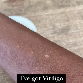 I've got Vitiligo